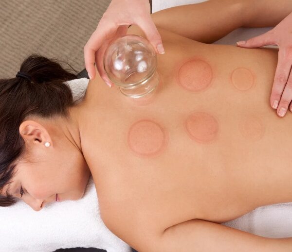 Cupping therapy treatment Stirling
